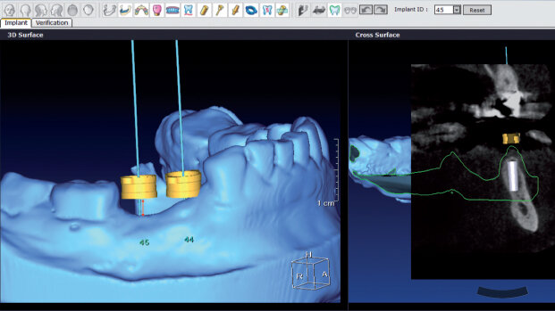 Implantologia digitale: risultati prevedibili estetici e funzionali