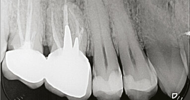 L’utilizzo della Cone Beam Computed Tomography (CBCT) in endodonzia clinica e chirurgica