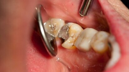 Dental filling failure linked to smoking, drinking and genetics