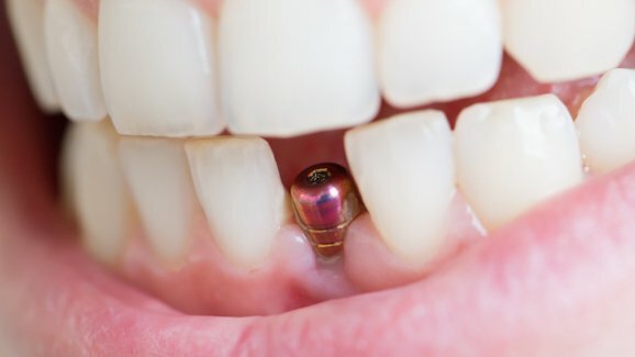 Conferência de Consenso Europeu libera atualização em implantes dentários