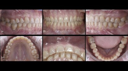 Interdisciplinary treatment of an adult patient with worn anterior teeth