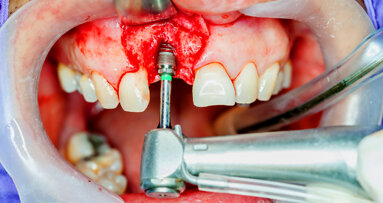 National standards for implant dentistry announced