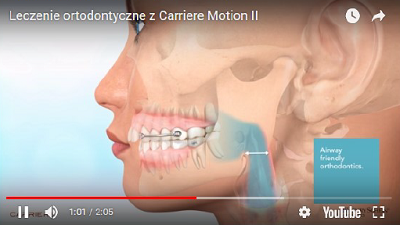 Leczenie ortodontyczne Carriere Motion Clear II z Invisalign