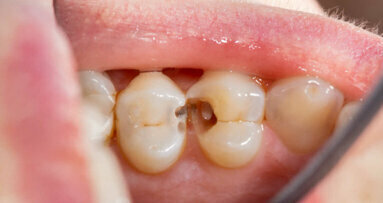 O estudo oferece novas visões sobre a doença periodontal e a resposta protetora do corpo