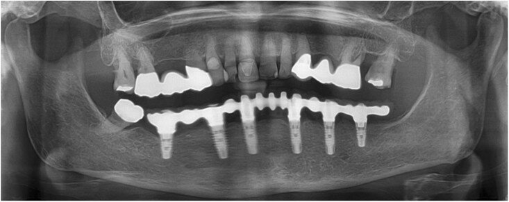 Fig. 16: Panoramic radiograph at the 12-month recall appointment.