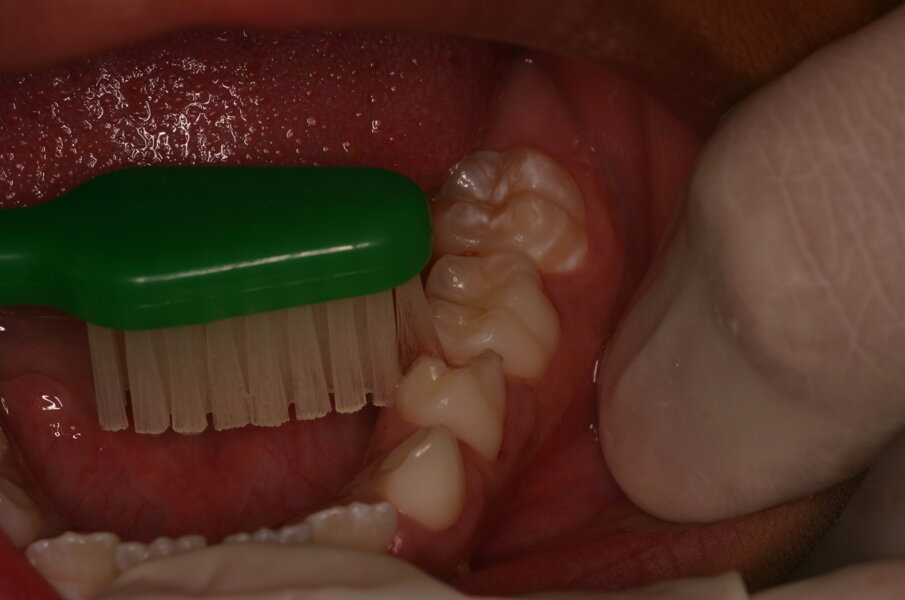 Afbeelding 4. Tandenborstel heeft toegang tot de caviteit en de cariogene plaque kan worden verwijderd. 