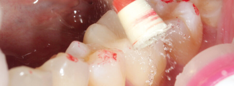 Fig. 15: Occlusal check followed by intraoral polishing with OptraPol