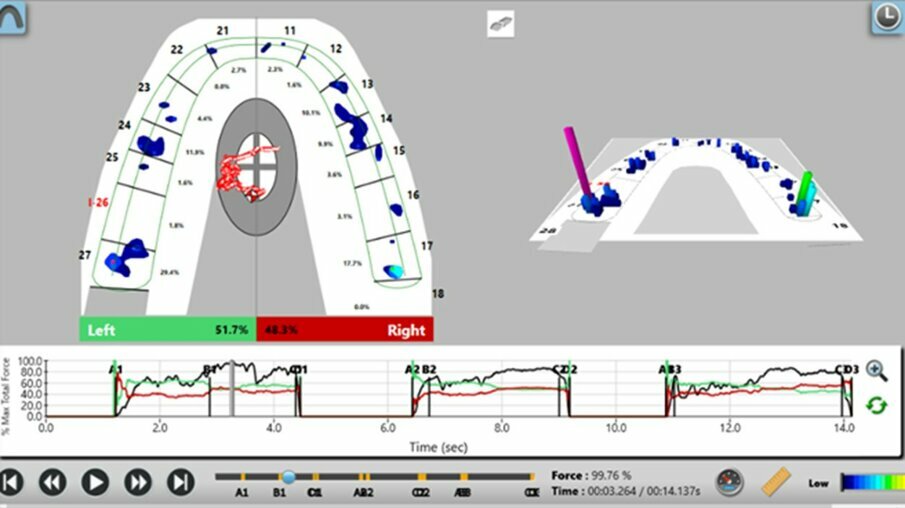 Fig 11: Initial scan before the treatment shows the patient has difficulty in holding the bite, the pink bar shows the point of maximum force, overall forces more on the left