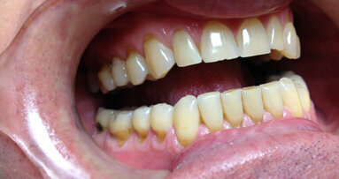 Nghiên cứu xem xét mối liên hệ giữa việc quản lý mòn răng và chất lượng cuộc sống