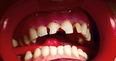 Nieuwe tandzorgverzekeraar voor ongevallen
