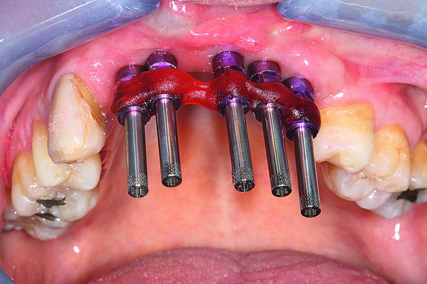 Fig. 18: The healing abutments were removed and replaced with pick-up impression copings secured with self-curing resin.