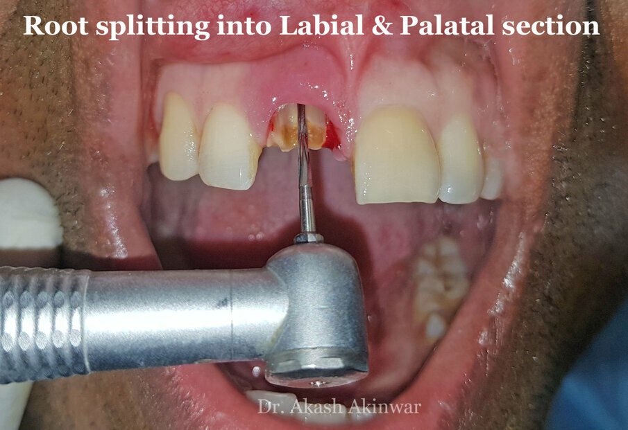 Fig 10: Splitting the root into buccal and palatal fragments