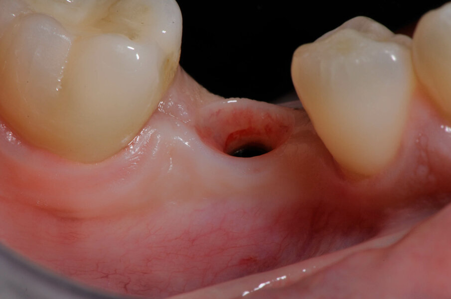 Fig. 14_La qualità dei tessuti del tragitto transmucoso grazie alla rilocazione del margine del pilastro implantare Dentsply Sirona Ankylos.