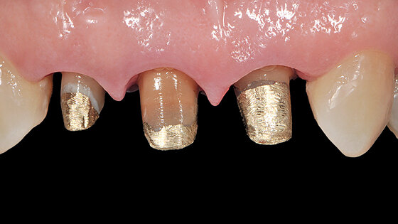 Mezi BOPT a BTA: Kazuistika zaměřená na tvarování gingiválního okraje kolem přirozených zubních pahýlů pomocí provizorních pryskyřičných korunek