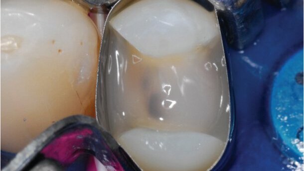 Clinical application of a new flowable base material for direct and indirect restorations