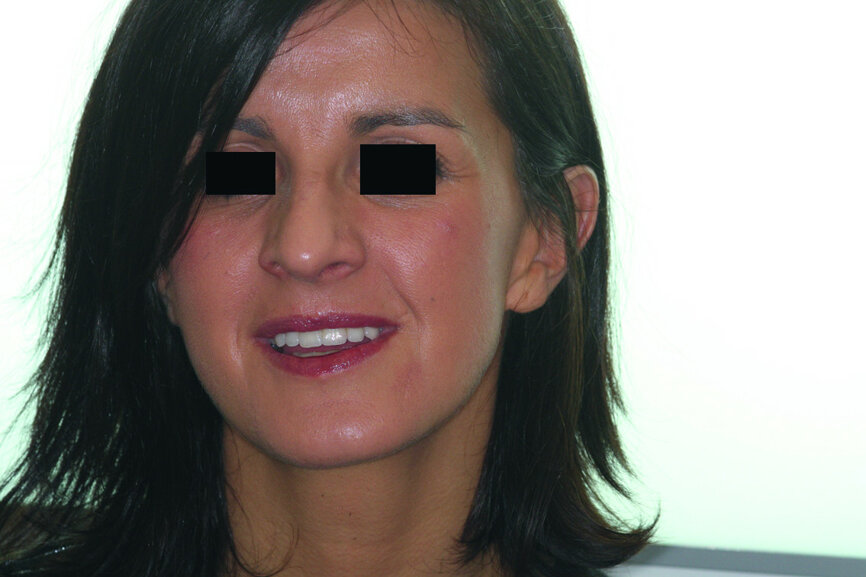 Fig. 39: Final cosmetic check-up showing correct lip support with the new extremely reduced false gingiva.