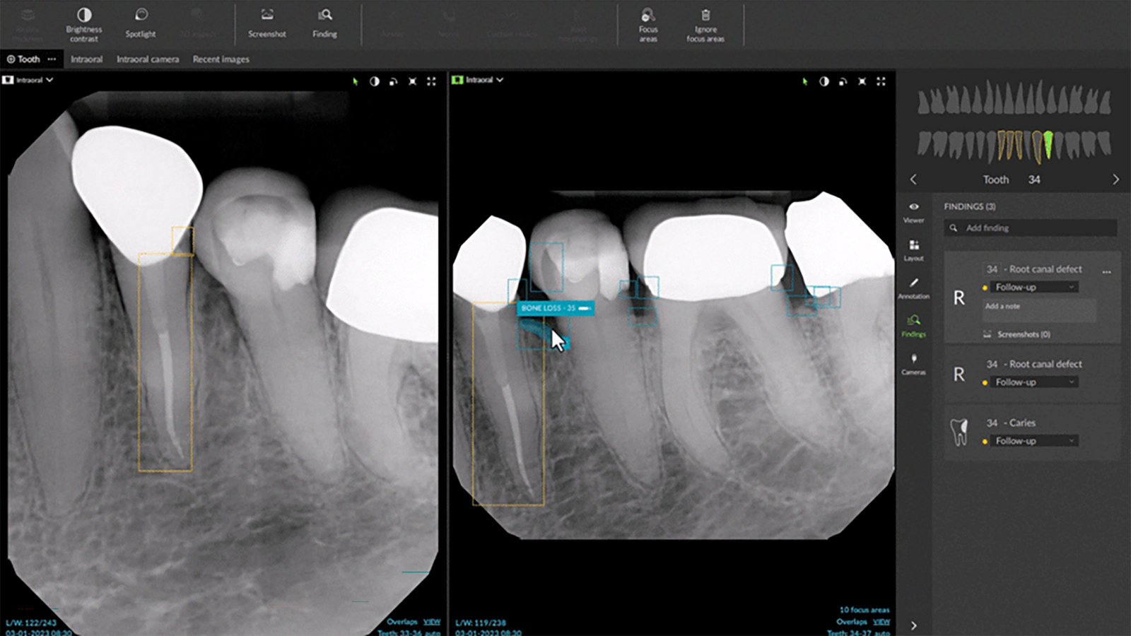 DEXIS Intraoralscanner mit offener & AI Bildgebungssoftware