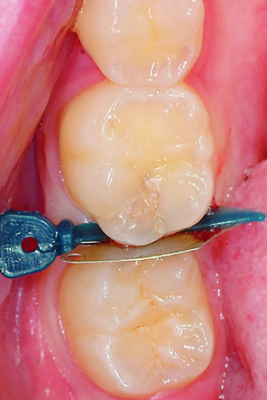 Insertion of the Palodent® V3 WedgeGuard before tooth preparation.