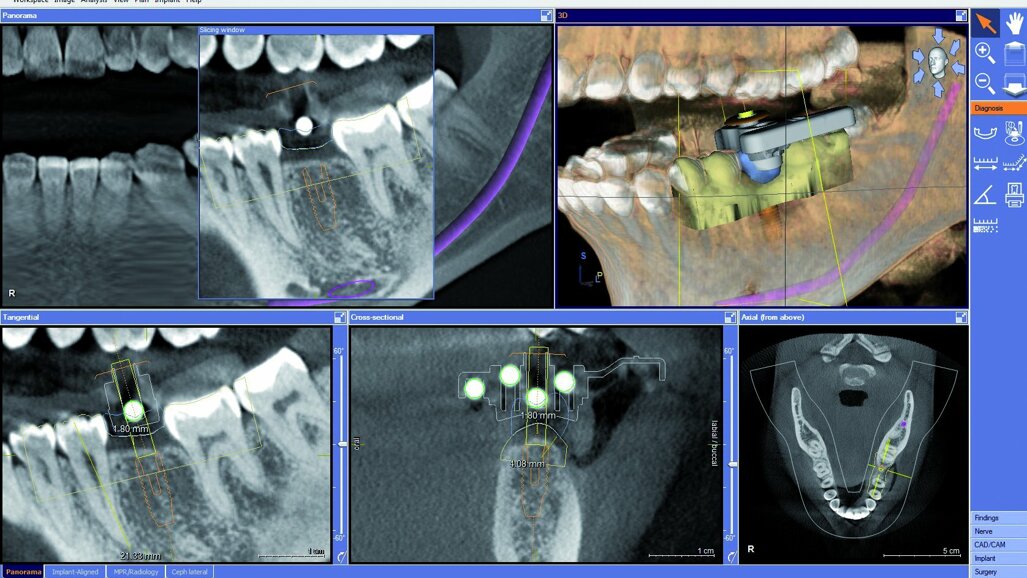 Pose chirurgicale d’implants guidée avec couronne CEREC fabriquée par CFAO