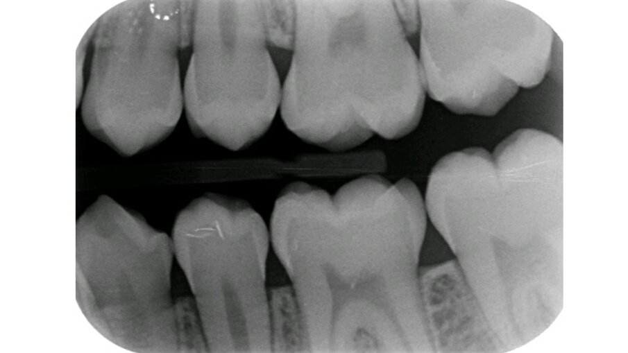 Afbeelding 2b. Bitewings van de blijvende dentitie. 