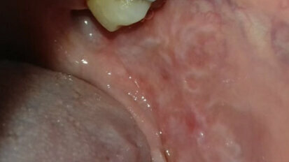 Allergie da contatto della mucosa orale