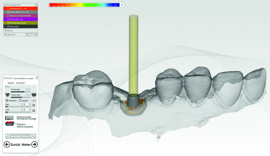 Fig. 9: The virtual titanium base as interface between implant and hybrid ceramic abutment crown.