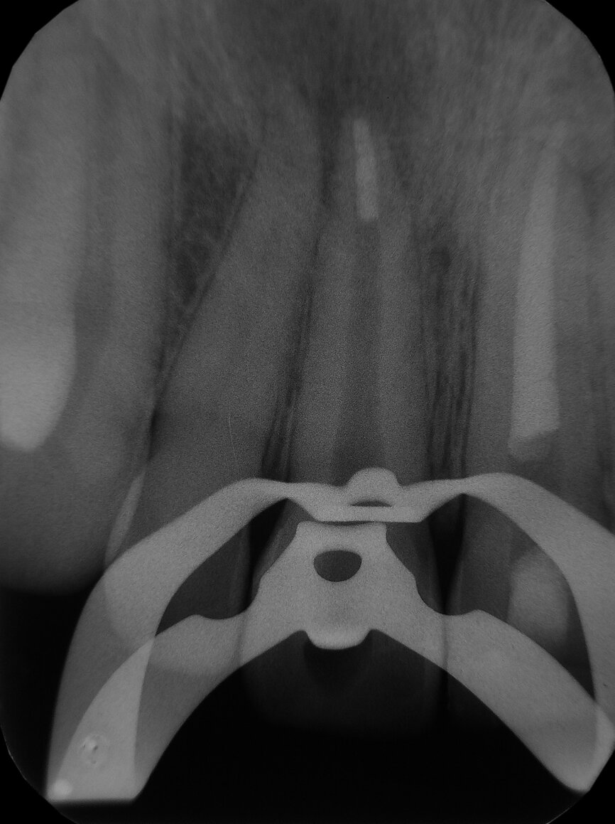 Fig. 5: Intraoperative radiograph of apical plug of tooth #11 (after 6 months from the first treatment).
