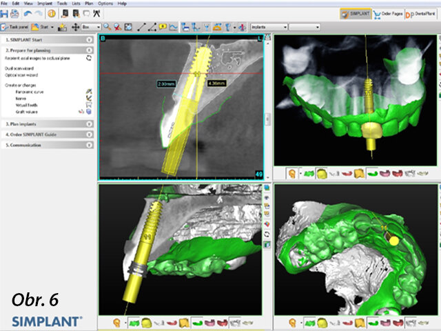 Spojení CBCT snímku, skenu CEREC a plánované pozice implantátu.