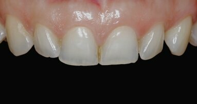 Flujo digital vs analógico: prueba en diez carillas cerámicas en el maxilar