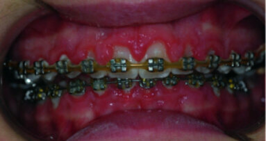 Use of diode laser in the treatment of gingival enlargement during orthodontic treatment