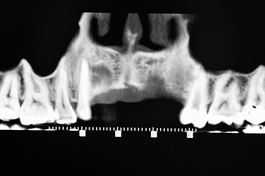 Fig. 5: Implant removal site showing even greater deterioration in bone volume.