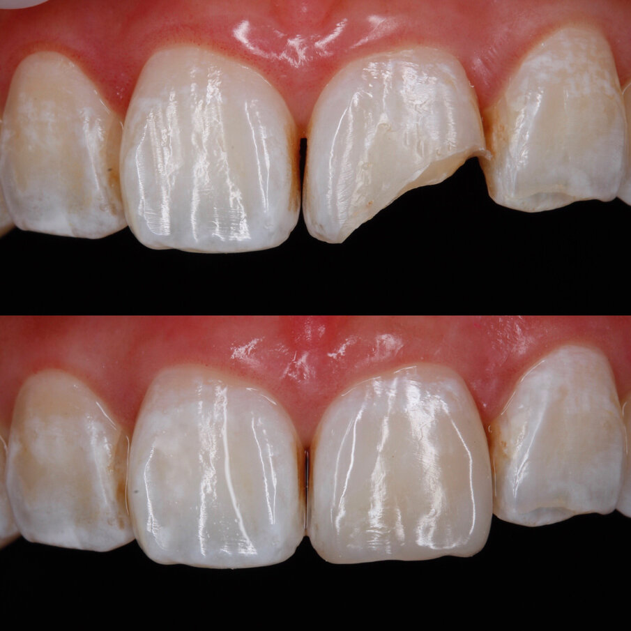 Fig 1: Before and after restoration with Beautifil II BioSmart composite