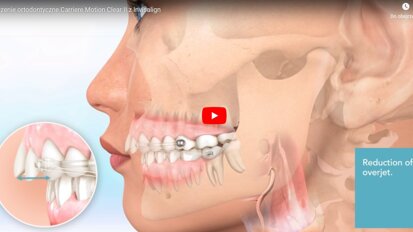 Leczenie ortodontyczne Carriere Motion Clear II z Invisalign