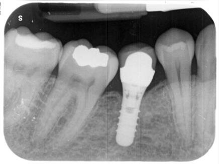Fig. 7 - Radiografia post-operatoria a conclusione della riabilitazione protesica dell’impianto in posizione 4.6.
