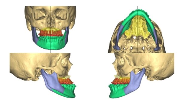 Zastosowanie technologii 3D oraz CAD/CAM w  chirurgii ortognatycznej – opis przypadku