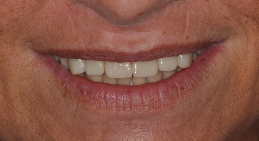 Fig. 16: Postoperative smile and lip profile