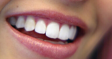 Μια νέα μέρα για ασθενείς και καταναλωτές: Ηλεύκανση δοντιών θα γίνεται μόνο από οδοντίατρους