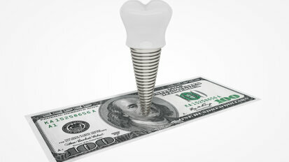 Dental implant market projected to reach US$5.9 bn by 2028
