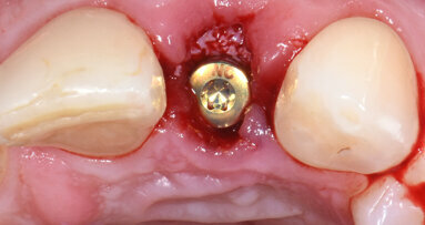 Dr Stephen Chen on principles for case selection in post-extraction implant placement