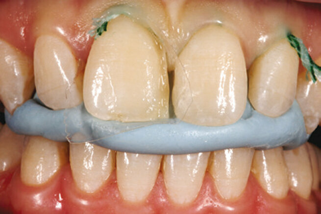 5. . Velikim pritiskom na traku postavljenu oko zuba omogućuje se reprodukcija palatinalne površine koja je prethodno dizajnirana u skladu s funkcijskim parametrima.