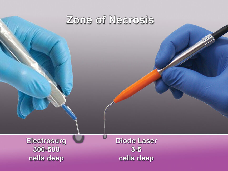 Fig. 2: Comparison of the depth of affected cells with an electrosurgery unit and a diode laser. (Photo provided by Dr. Gregori M. Kurtzman)