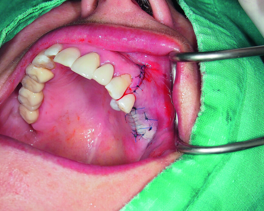 Fig. 10: Wound closure with monofilament sutures.