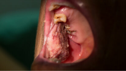 I tumori orali potrebbero non essere rilevati durante la crisi sanitaria del Covid-19