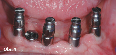 Otiskovací pilíře usazené na implantátech. Jeden implantát je vyřazen z návrhu a překryt vhojovacím válečkem.