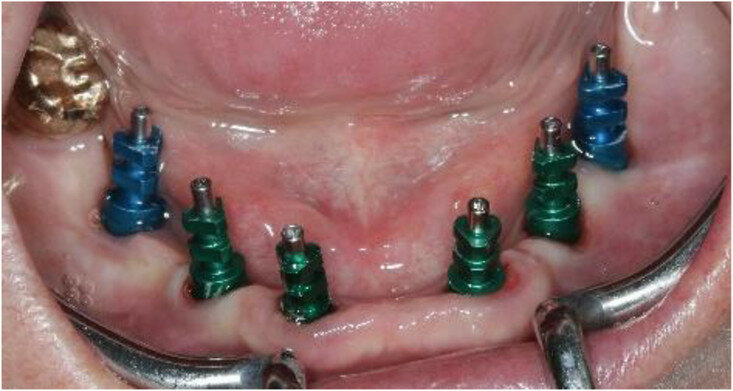 Fig. 11: Frontal view showing the screw-retained posts at impression taking 24 weeks after implant placement.