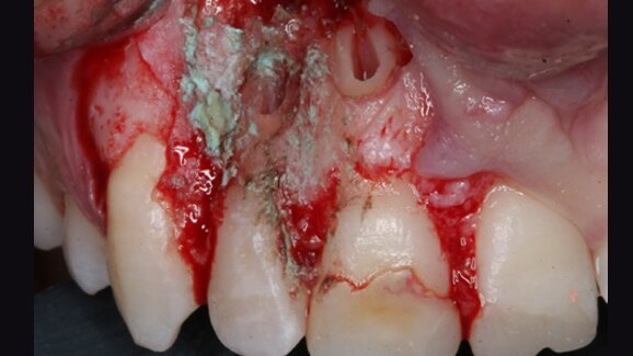 Bone block graft to treat an apicomarginal defect simultaneously with apical surgery of the maxillary incisors: A case report with three-year follow-up