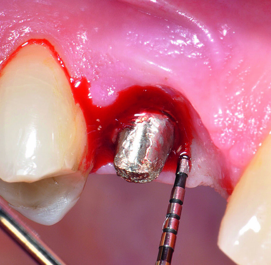 Fig b : Implant en position 14 affecté par une péri-implantite : sondage péri-implantaire après retrait de la couronne prothétique. 