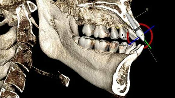 3D imaging: Increasing implant accuracy
