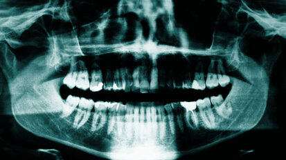 Meeste röntgenfoto’s bij tandarts zijn overbodig