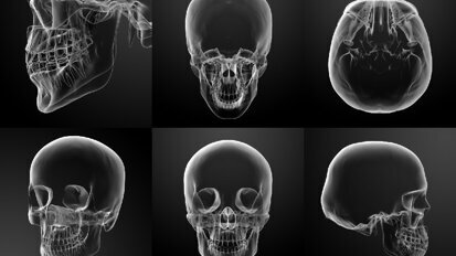 La modellazione 3D in chirurgia maxillo-facciale: intervista a Guglielmo Ramieri